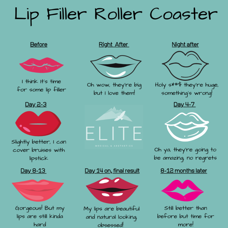 Tips to Reduce Lip Filler Swelling and Bruising Elite Medical