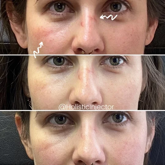 Womans face before and after resurfx on nose