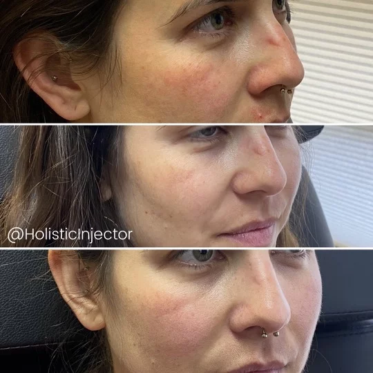 side profile before and after resurfx on cheeks