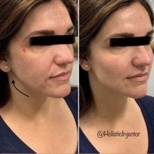 Before and after of EMA clients with Radiesse in cheeks and chin