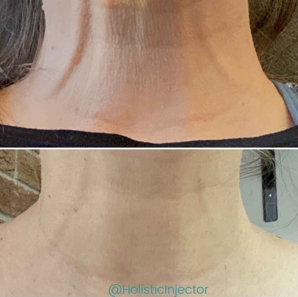 Laser Skin Tightening Before and After on Neck