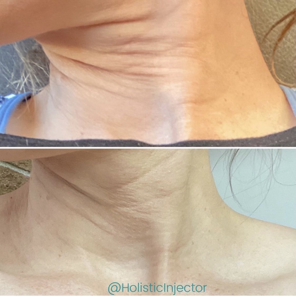 Before and After Laser Skin Tightening on Neck