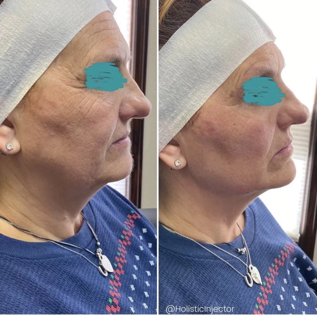 chin filler before and after