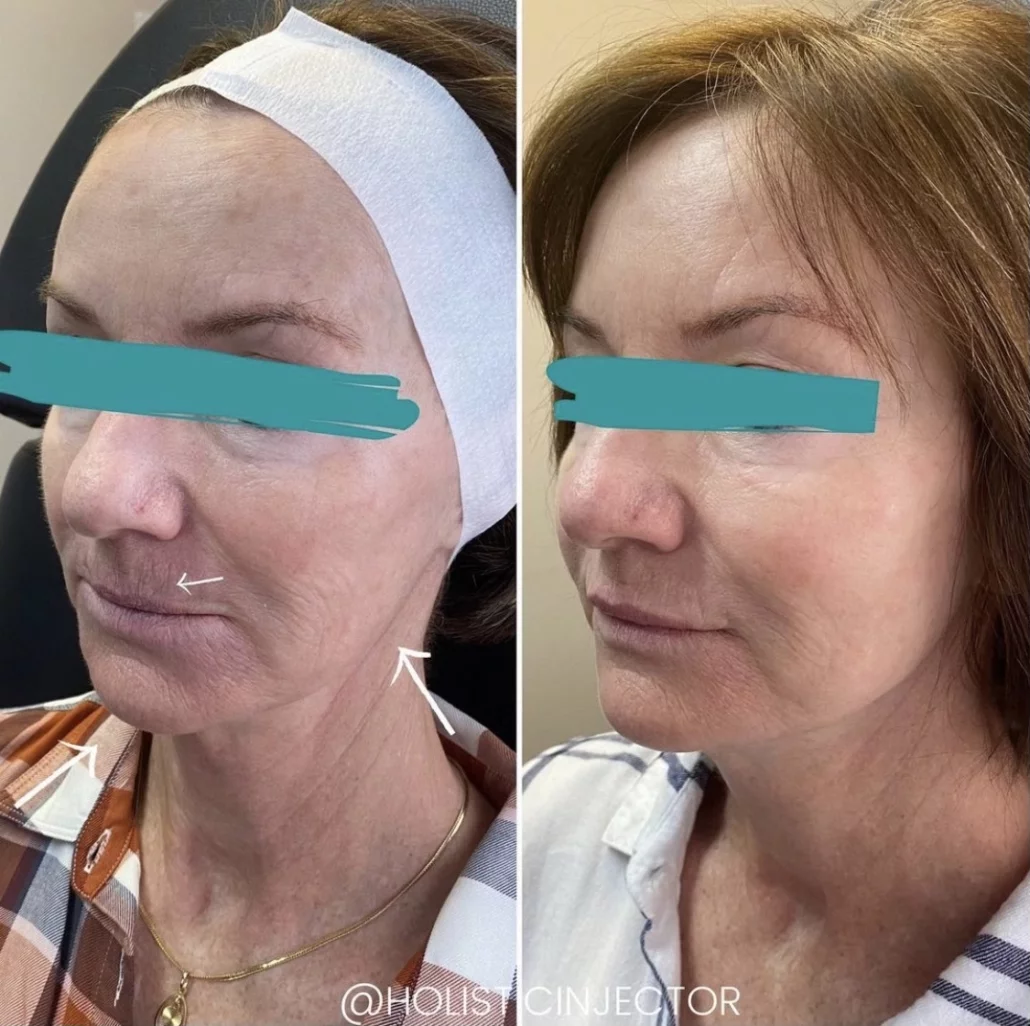 before and after chin filler