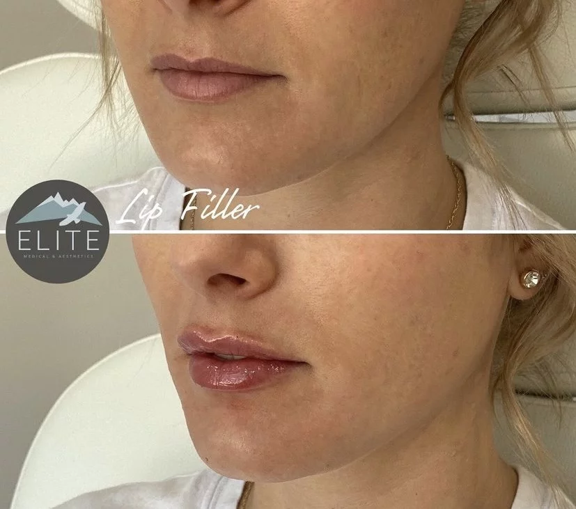 The Best Lip Filler | Elite Medical & Aesthetics | Lone Tree, CO 80124