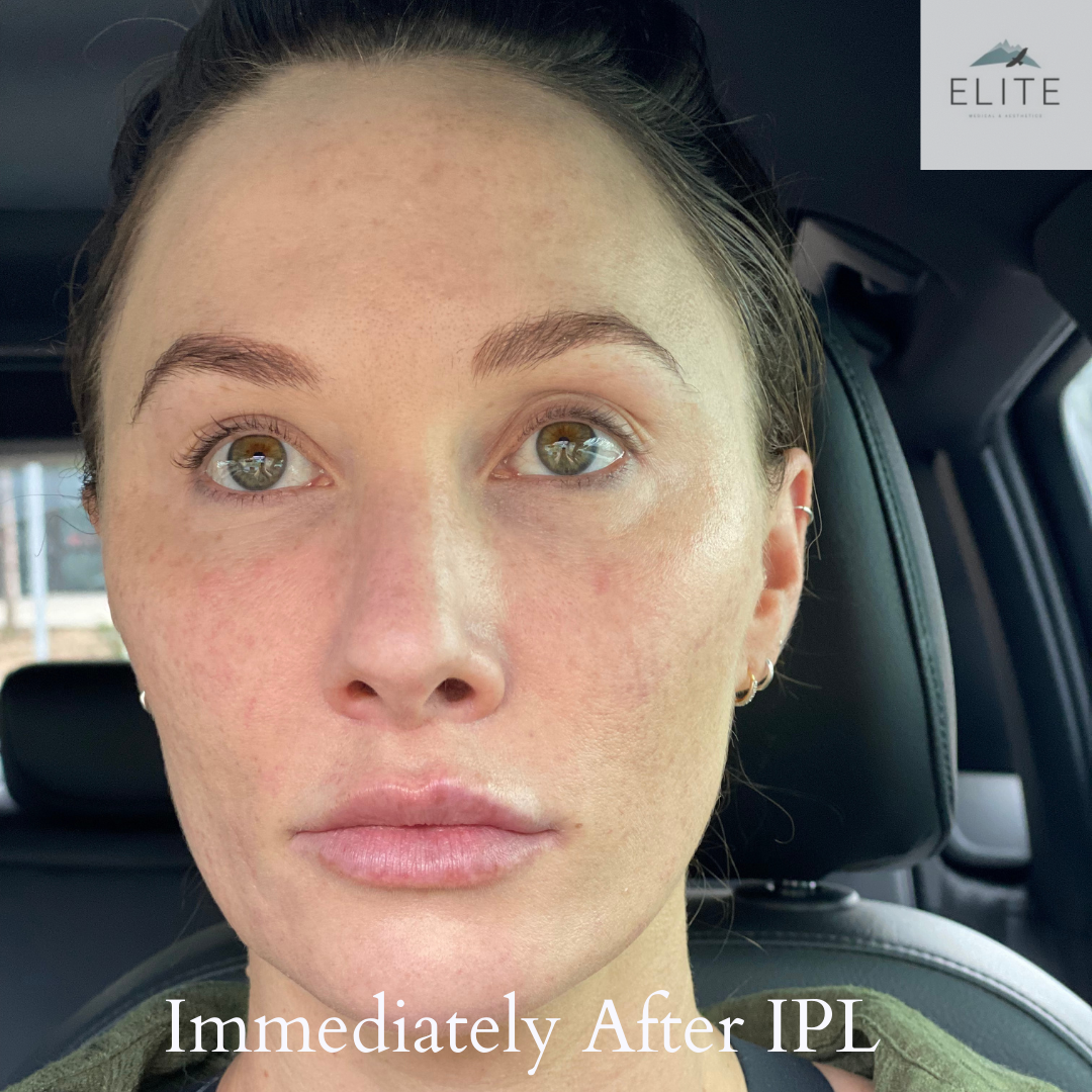 What to expect after an IPL Elite Medical & Aesthetics Lone Tree