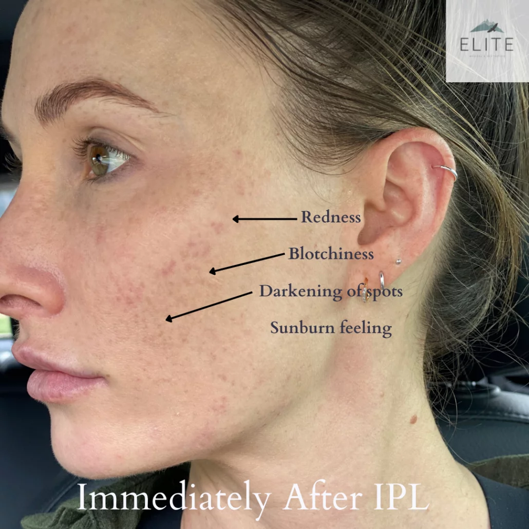 What to expect after an IPL, Elite Medical & Aesthetics