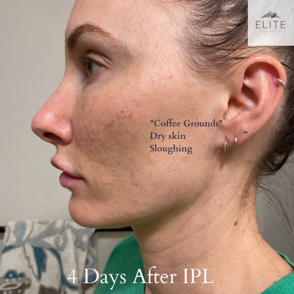 What to expect after an IPL, Elite Medical & Aesthetics