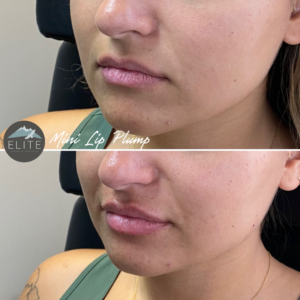 EMA client Before and after Revanesse Versa lip filler