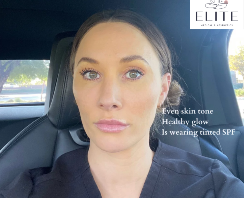 All About Under Eyes Elite Medical & Aesthetics Lone Tree, CO 80124