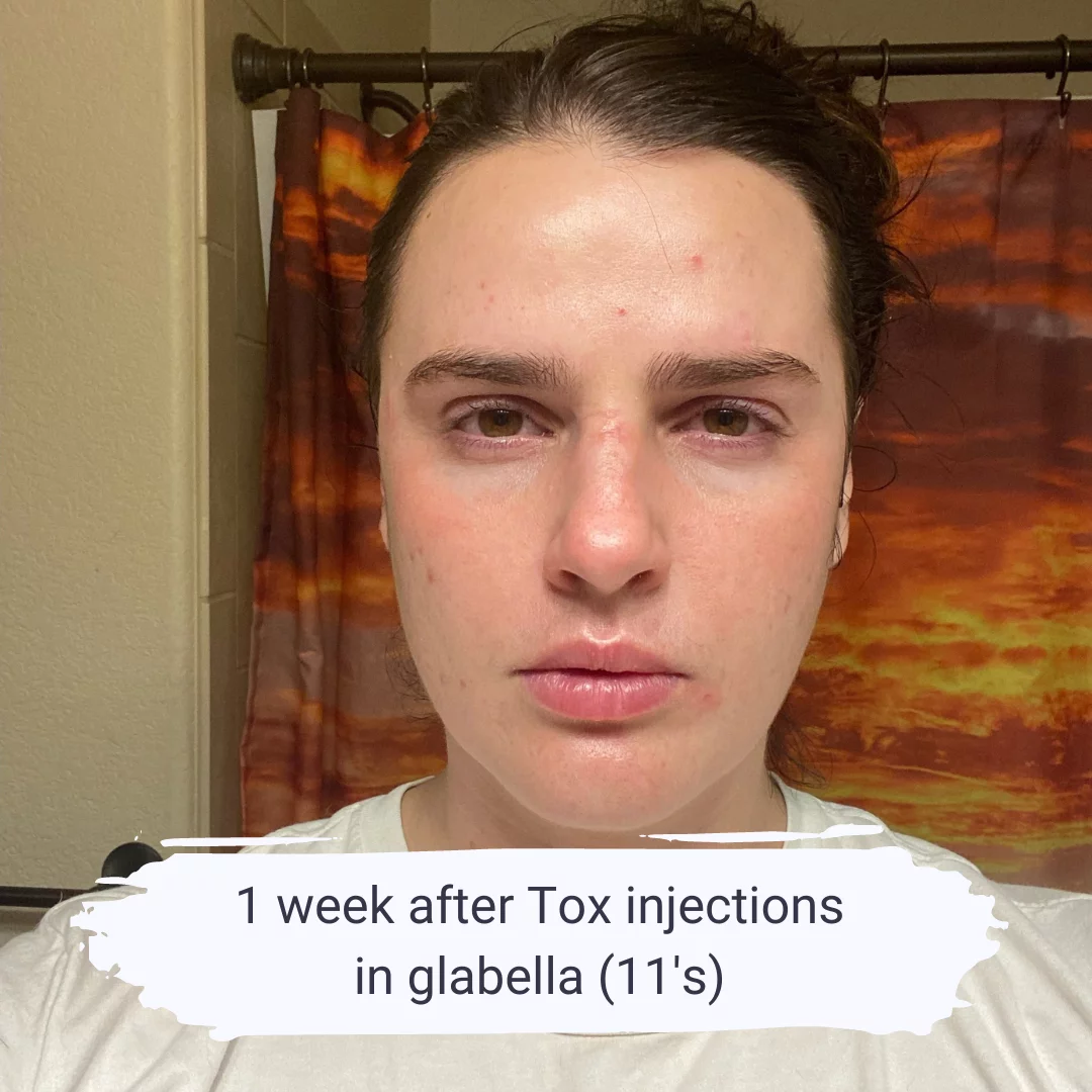 How Botox Kicks In | Elite Medical & Aesthetics | Lone Tree, CO 80124