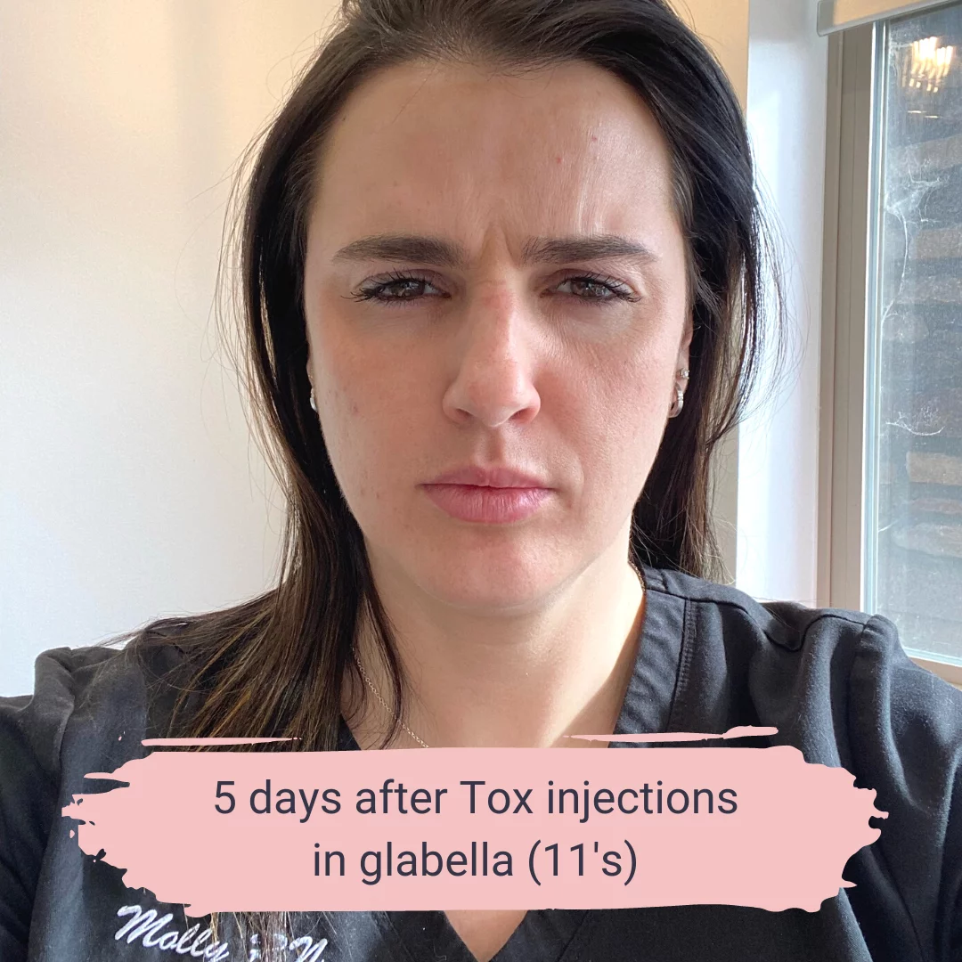 How Botox Kicks In | Elite Medical & Aesthetics | Lone Tree, CO 80124
