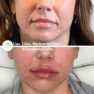 View of Elite Medical and Aesthetics’s patient before and after Revanesse Versa filler