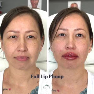 Top view of before and after of EMA client’s lips after Revanesse Versa lip filler