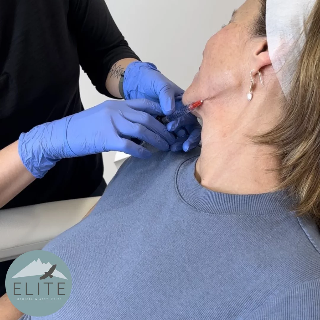 Jawline Filler 101 | Elite Medical & Aesthetics | Lone Tree, CO 80124