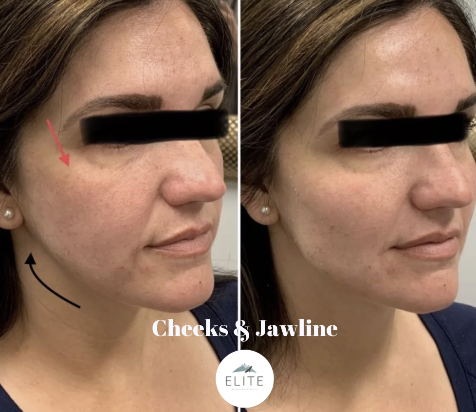 Jawline Filler Near Me Enhancing Facial Definition