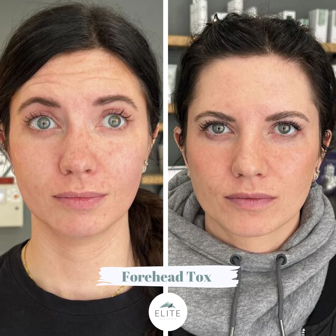 Why Couples Fight About Botox| Elite Medical & Aesthetics | Lone Tree ...